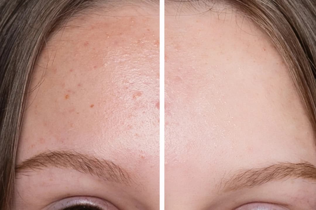 Hydroderma Facial Treatment - Image 4