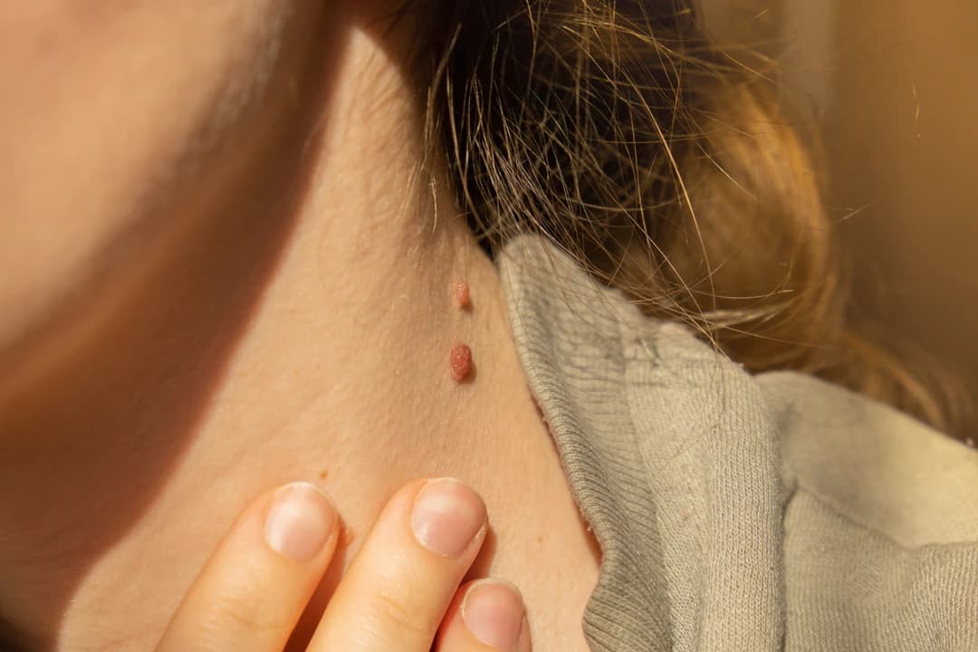 Skin Tag Removal - Image 1