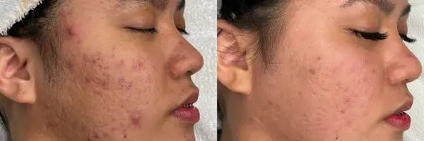 HydraFacial (Platinum Anti-Acne)