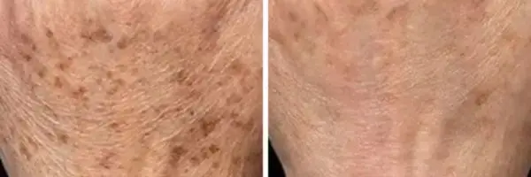 Laser Pigmentation Removal